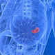 Illustration for article titled Woman Has Her Breasts and Uterus Removed—and She Didnt Even Have Cancer